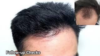 Hair Transplant Malaysia | SMART™️ FUE Frontal Male Hair Transplant (7 Months Result)