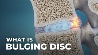 What Is a Bulging Disc? | @Atlantic Spine Center