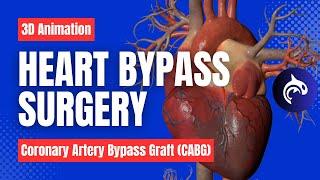 How Heart Bypass Surgery Works (Coronary Artery Bypass Graft CABG) - 3D Animation