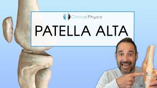 Patella Alta | Expert explains Diagnosis, Assessment and Treatment