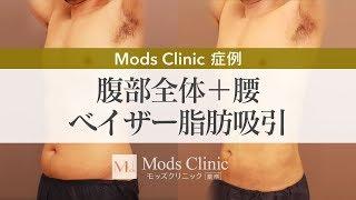 腹部全体+腰 ベイザー脂肪吸引【モッズクリニック症例チャンネル】