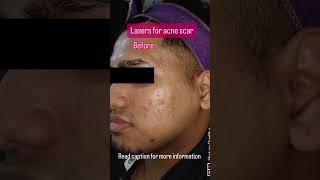 #shorts Lasers for acne scars | Dr Rashmi Aderao