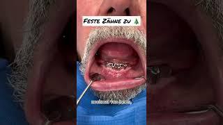 Feste Zähne mit IMPLANTATEN #zahnimplantate #implantat #zahnersatz #zahnprothese #festezähne