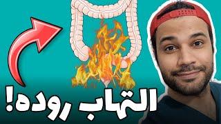 بیماری کرون | التهاب روده | crohn's disease