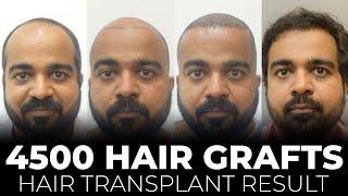 4500 Hair Grafts Transplant | Sapphire Hair Transplant Results