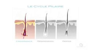 L'Épilation au Laser : comment ça marche ?