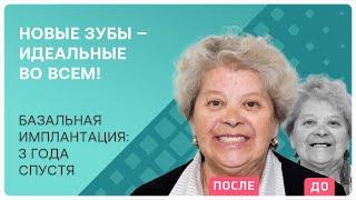 Базальная имплантация всех зубов  отзыв через 3 года