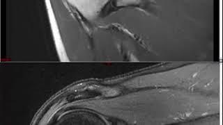 Shoulder MRI (Approach to MSK MRI Series)