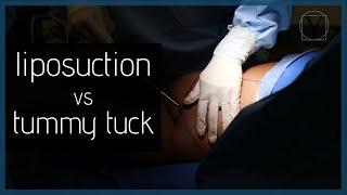 Liposuction vs Tummy Tuck | Y Plastic Surgery