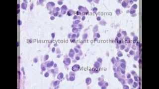 Bladder pathology topic 6 Urothelial Carcinoma and Its Variants