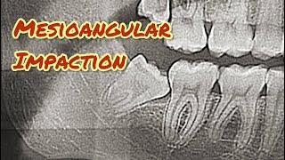 Mesioangular Wisdom Tooth Extraction Video Step-by-Step @drwahan