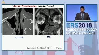 ERS London 2018, Chronic Invasive Fungal Sinus Disease - Evolving Techniques, Islam Herzallah