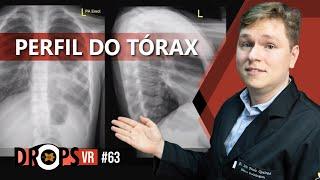 A IMPORTÂNCIA DO PERFIL NA RADIOGRAFIA DO TÓRAX