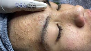 Acne treatment for Spa Linh Mun 2024 #134