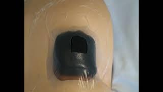 Utilizzo della Vacuum Assisted Closure Therapy per il trattamento delle lesioni da pressione.