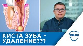 Киста зуба лечить или удалять