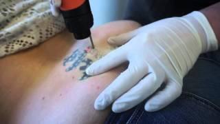 See Her Getting Laser Tattoo Removal Treatment by Dr. Jason Emer, MD Beverly Hills, California