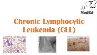 Chronic Lymphocytic Leukemia (CLL): Symptoms (ex. Skin Blisters), Diagnosis and Treatment (Vit D?)