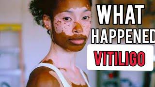 Vitiligo+Rewatching Sarafina+Leleti kumahlo and late Michael Jackson (Vitiligo patients)