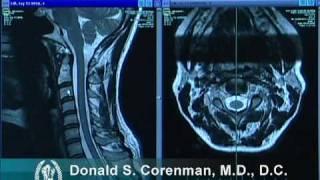 How to Read a MRI of the Normal Cervical Spine (Neck) | Colorado Spine Expert