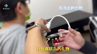 【鈣化性肌腱炎】超音波導引抽除鈣化