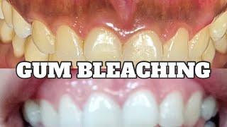 MAITIM NA GILAGID: Gum bleaching