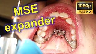  MSE - Maxillary Skeletal Expander MARPE