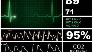 Hospital Monitor Flatline to Alive (SD)