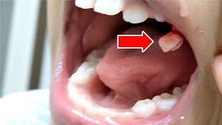 A 10-year-old girl pulls out her tooth by herself!! The moment when a tooth comes off