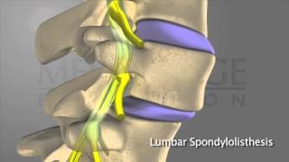 Treatment of the Lumbar Spine Video: Chad Cook | MedBridge