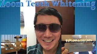 Zoom Laser Teeth Whitening Review | Is It Worth The Money?