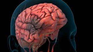 Stroke | Nucleus Health