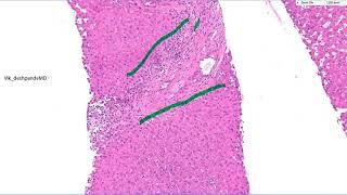 Focal nodular hyperplasia