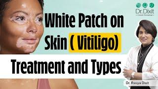 White Patches on Skin | Vitiligo Skin Disease Treatment | Types of vitiligo | Dr. Rasya Dixit