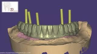 Exocad : Perfecting Your Lower Full Arch Implant Designs At DIGIART DESIGN SERVICES