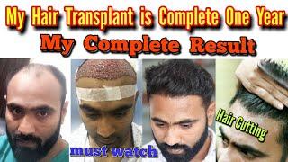 Hair Transplant || One Year Hair Transplant Journey ||