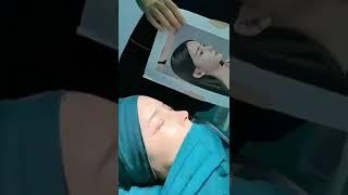 Rhinoplasty, nasal synthesis