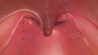 Sphincter Pharyngoplasty to Treat VPI