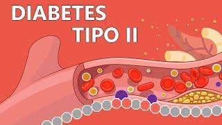 Type 2 Diabetes - Easily Explained to Patients