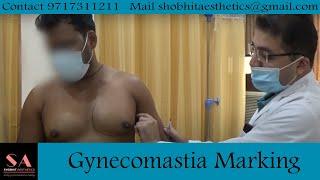 Gynecomastia Planning And Marking Before Surgery By Dr. Shobhit Gupta #gynecomastia #marking