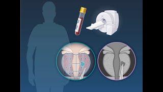 PSA and MRI Prostate Cancer Screening | NEJM