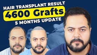 Hair Transplant Clinic In Bhopal || Cost & Result of Hair Transplant in Bhopal || @hfhgclinic