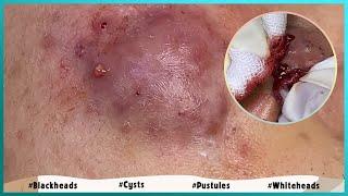 Big Cystic Acne Blackheads Extraction Blackheads & Milia, Whiteheads Removal Pimple Popping