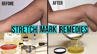 HOW TO GET RID OF STRETCH MARKS & SCARS + DIY AT HOME STRETCH MARK CREAM