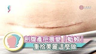 【產後修復】剖腹產疤痕變「蚯蚓」如何預防與除疤？｜陳志軒醫師｜禾馨形體美學｜寶貝幫X馨講堂 45