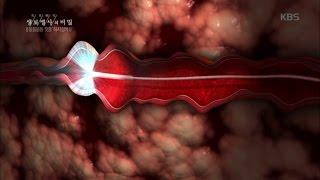 생로병사의 비밀 - 하지정맥류 수술 방법과 특징.20161012