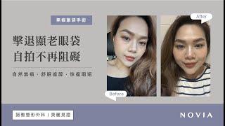 【諾雅美妍所｜美麗見證】無痕眼袋手術實例｜擊退顯老眼袋，自拍不再阻礙【李昱恆醫師】