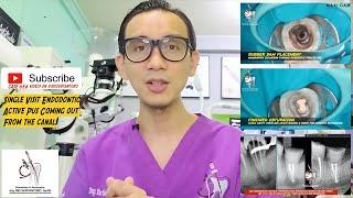 2 YEARS FOLLOW UP OF SINGLE VISIT ROOT CANAL TREATMENT IN 2ND MOLAR WITH PUS  BONE REGENERATION 