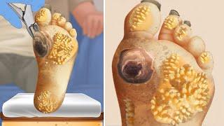 ASMR | Best Way to Take Care Feet - Remove Dead Skin and Mold on Feet | Animation