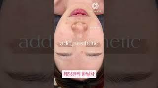 #문제성피부 #모세혈관확장증 #모낭염 #여드름 #웨딩관리 #물광관리 #맞춤웨딩관리 #애드에스테틱